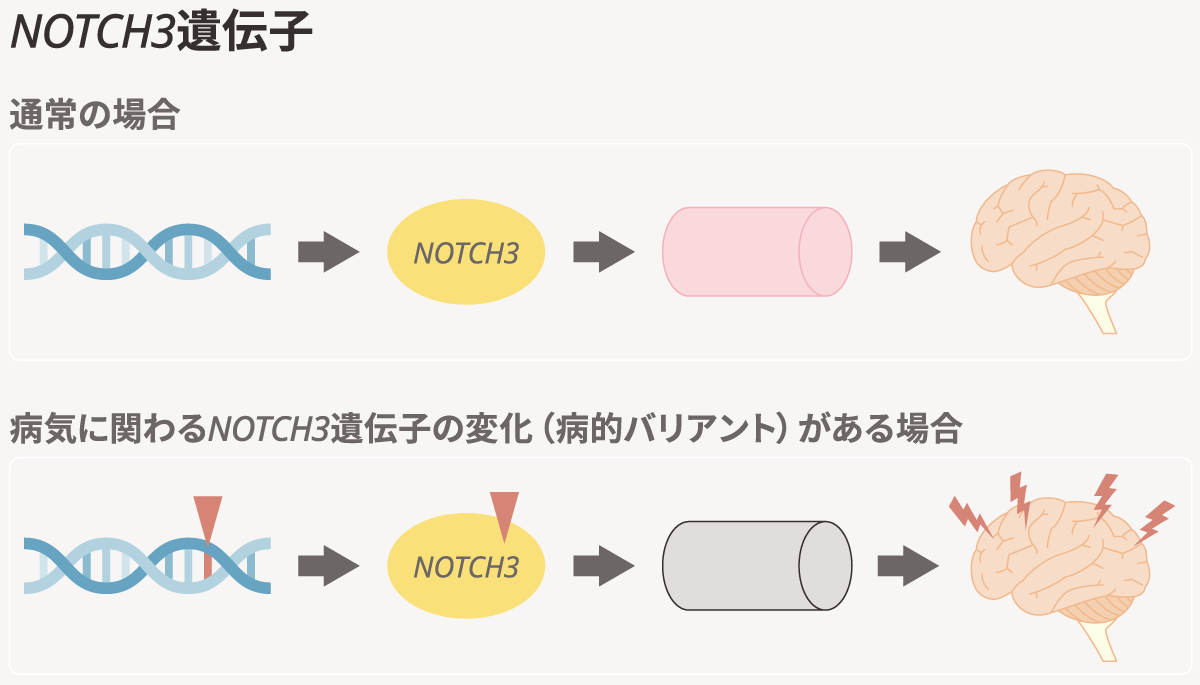 CADASIL患者さんの脳MRI画像