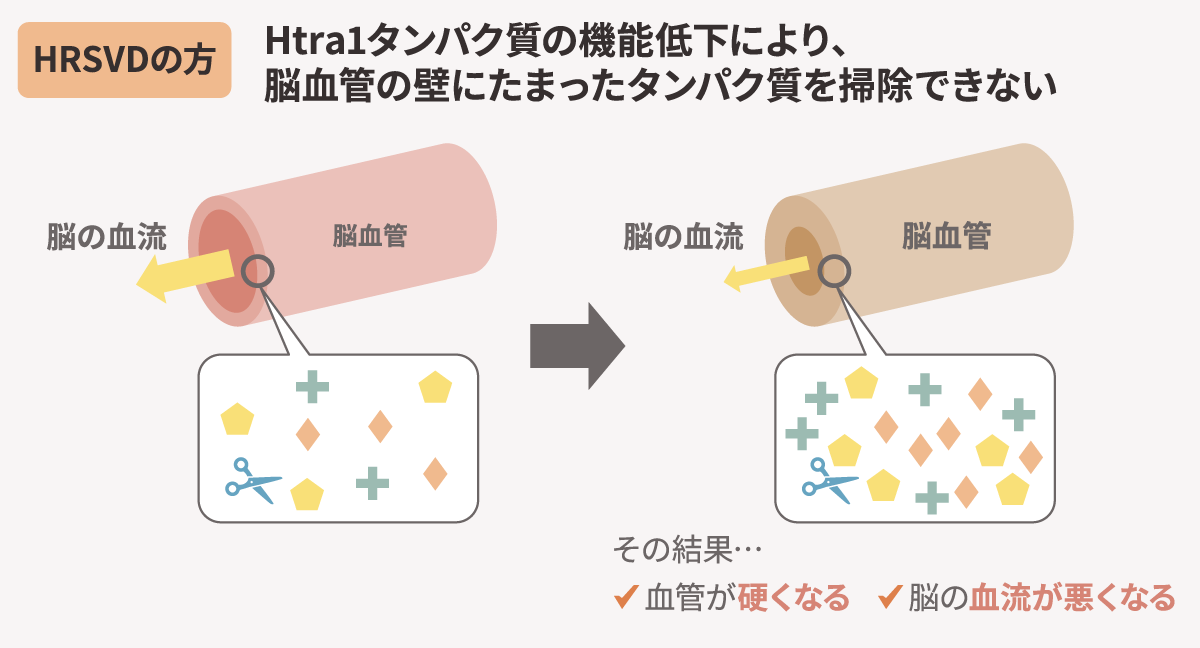 HTRA1の機能低下により、脳血管の壁に溜まったタンパク質を掃除できない